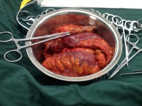 切除息肉可以吃蜜瓜